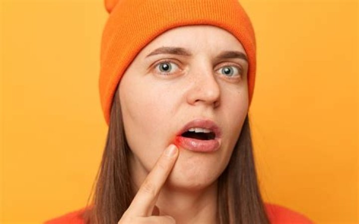 Les traitements Naturel de la Perlèche : Tout ce que vous devez savoir